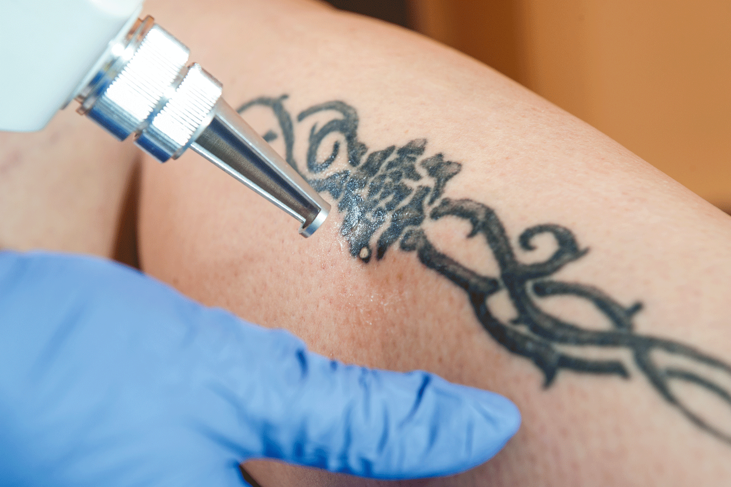 Como se especializar no trabalho de remoção de tatuagens
