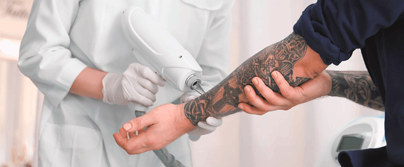 Como se especializar no trabalho de remoção de tatuagens